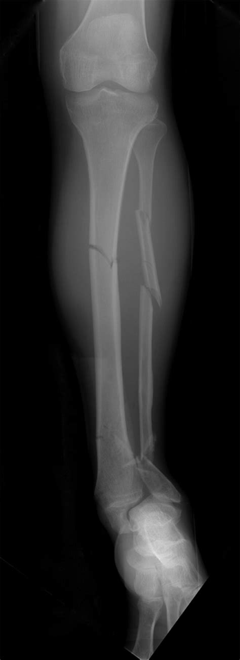 Treatment Of Checkrein Deformity Of The Hallux Bone And Joint