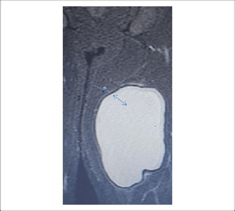 A 30 Year Old Man Presented With A Mass In The Right Medial Thigh Download Scientific Diagram