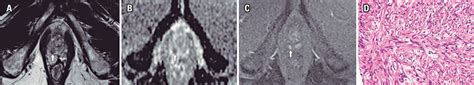 Scielo Brasil Multiparametric Magnetic Resonance Imaging Findings