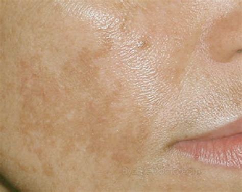 Brown Spots on Face | Symptoms Causes Treatment and Prevention of Diseases