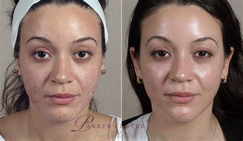 Advanced Acne Treatment Before And After Pictures Case 327 Paramus Nj Parker Center For