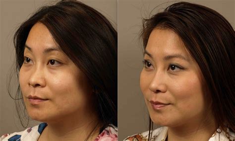 Asian Rhinoplasty Before And After