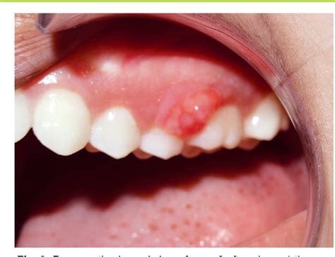 Figure From Treatment Of Peripheral Ossifying Fibroma Using Er Cr