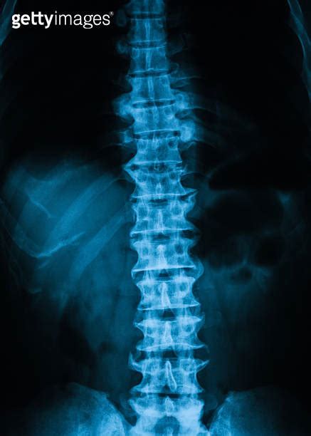 X Ray Image Of Thoracolumbar Spine T L Spine