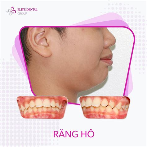 Răng hô là như thế nào Nguyên nhân và giải pháp khắc phục hiệu quả