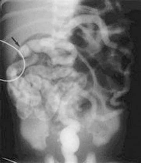 Meconium Ileus : filling defect in the distal small bowel with small ...