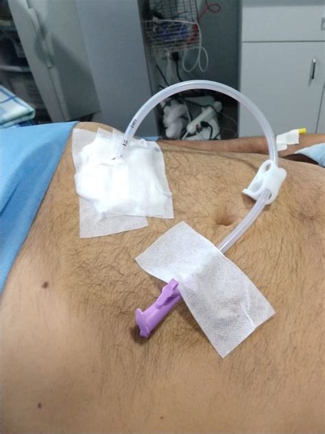 Peg Percutaneous Endoscopic Gastrostomy Dr Fernando Hidalgo