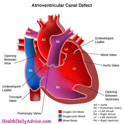 Atrioventricular Block - First, Second, Third Degree - Symptoms