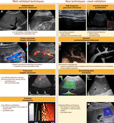 Update On Ultrasound Imaging Of Liver Fibrosis Journal Of Hepatology