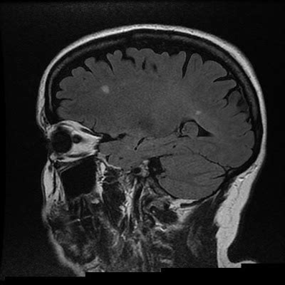 Radiology Cases: MS presenting with severe headache