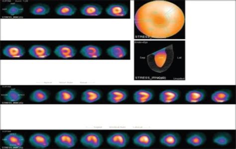 Normal Myocardial Distribution Of Technetium M Sestamibi In Static