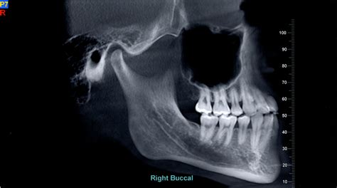 Recovery Timeline | A Tale of Two-Jaw Surgery