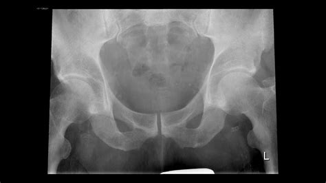 Pelvic Radiograph Part 6 Youtube