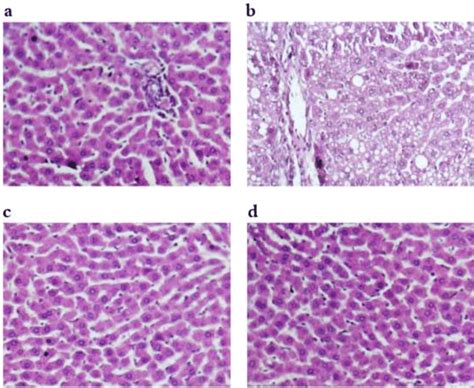 Histopathological Picture Of A Liver Sections From Normal A Diseased