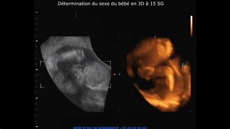 Détermination Du Sexe Du Bébé En 3d à 15 Sg Youtube