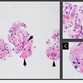 Glomerulus With Capillary Thrombi A Capillary Thrombi Arrow