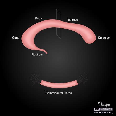 Corpus callosum (illustration) | Radiology Case | Radiopaedia.org