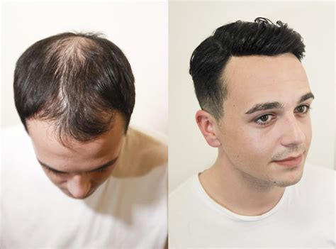 Male Pattern Baldness Everything You Need To Know Fashionbeans