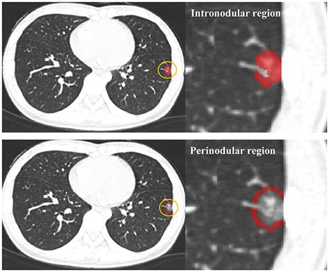 Frontiers Ct Imaging Based Analysis Of Invasive Lung Adenocarcinoma Presenting As Ground Glass