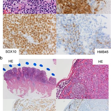 Pathological Results Of A The Specimen Obtained From Endobronchial