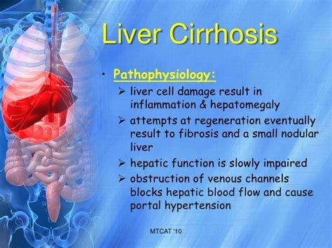 Liver Cirrhosis