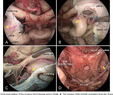 Figure 4 From Surgical Anatomy Of The Superior Hypophyseal Artery And