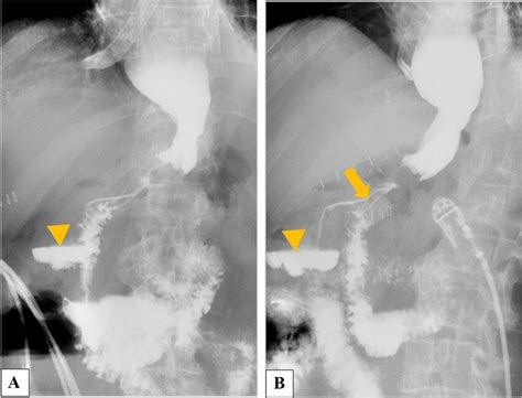 Ivor Lewis Esophagectomy A Ap Positioning Of The Patient Revealed