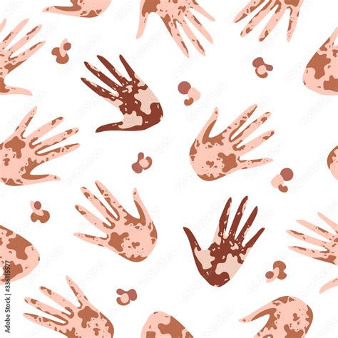 Vitiligo seamless pattern of Hands High five. Pattern with hands with ...