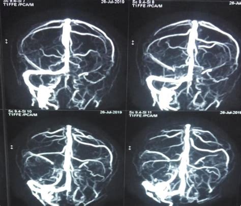 Intracranial And Extracranial Complications Of Chronic Otitis Media And