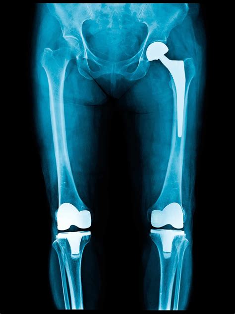 Total Joint Replacement - Heiden Orthopedics