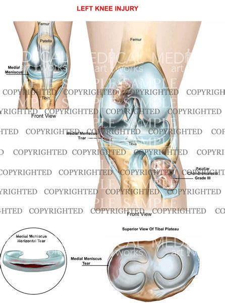 Left Knee Medial Meniscus Horizontal Tear — Medical Art Works