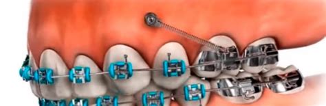 Qu Son Los Microtornillos De Ortodoncia Ortoimplants Premium