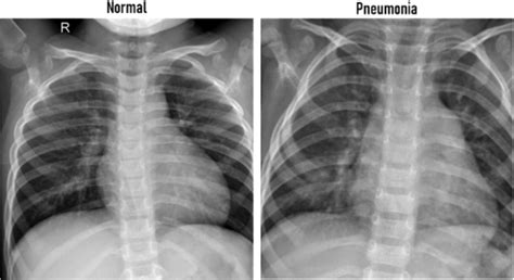 Pneumonia Chest X Ray Diagnosis