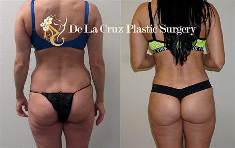 Pin On Before After Photos Of 4D VASER Liposculpture