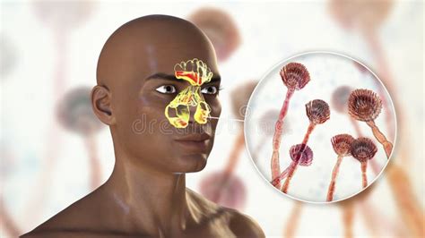 Aspergillus Fungi As A Cause Of Sinusitis 3d Illustration Stock