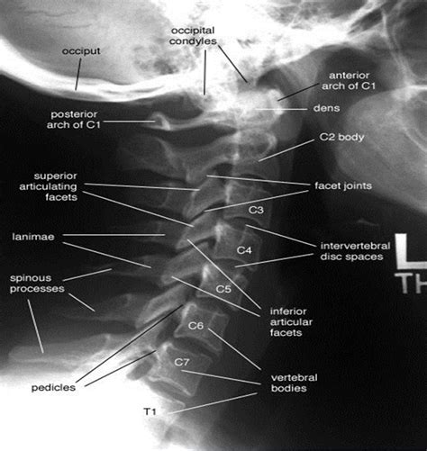 Normal C Spine Radiology Student Medical Anatomy Diagnostic Imaging