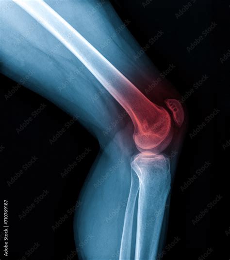 Knee joint x-ray (AP and LATERAL) view fracture and displacement of the ...