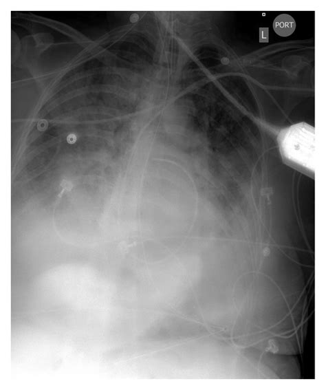 Chest X-ray of an ARDS victim that suffered a grade 4 SAH. | Download ...