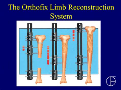 Lengthening Limb Reconstruction