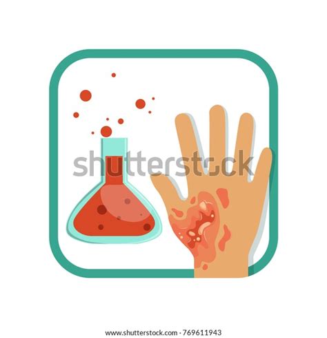 110 Third Degree Burn Vector Stock Vectors Images And Vector Art