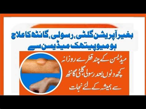 Gilti Aur Rasoli Ka Homeopathic Ilaj A Natural Treatment Youtube