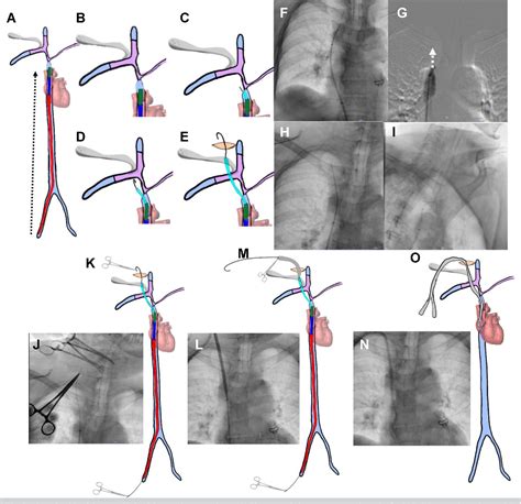 Figure 2 From Comparison Of Catheter Patency Between Surgical Inside