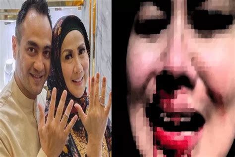 Beredar Foto Wajah Venna Melinda Berlumuran Darah Diduga Dipukuli Ferry