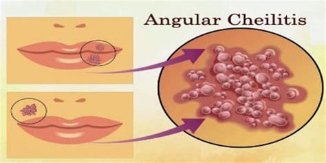 Angular Cheilitis Or Cold Sore