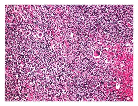 Inguinal Lymph Node Examination Shows Mixed Cellular Type Hd With Download Scientific Diagram