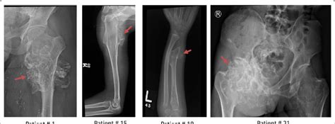 Osteochondroma Radiology