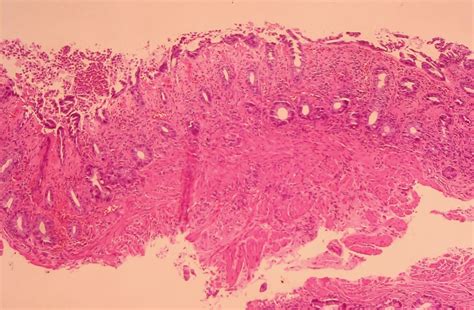 Gastrointestinal And Liver Histology Pathology Atlas Colon Ischemic