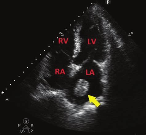 Transthoracic Echocardiography Apical Four Chamber View Showing An