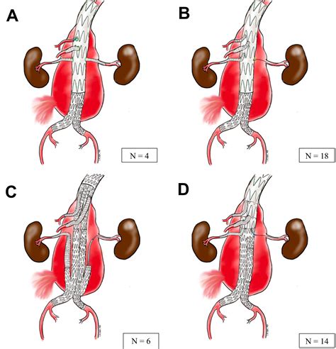 Comparative Early Results Of In Situ Fenestrated Endovascular Aortic