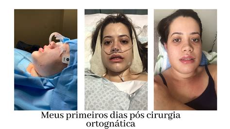 MEUS PRIMEIROS DIAS PÓS CIRURGIA ORTOGNATICA UM SONHO REALIZADO